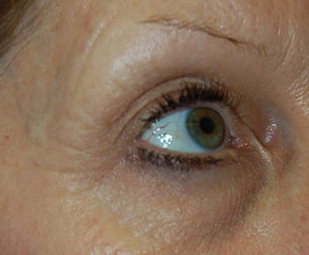 Reduction in crow's feet following Smartxide DOT CO2 fractional laser skin resurfacing